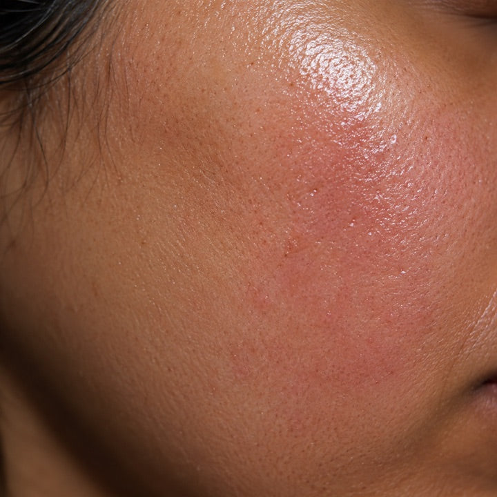 Close-up of tight, shiny, flushed skin — overworked, reactive skin